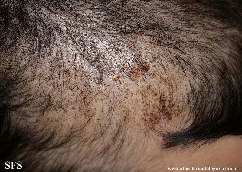 File:Trichotillomania (Dermatology Atlas 14).jpg