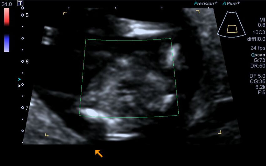 1st trimester nuchal-morphology ultrasound (Radiopaedia 44706-48477 Heart views cine with colour 174).jpg