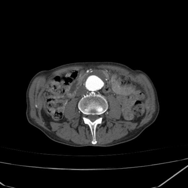 File:Abdominal aortic aneurysm (Radiopaedia 23703-23856 Axial C+ arterial phase 43).jpg