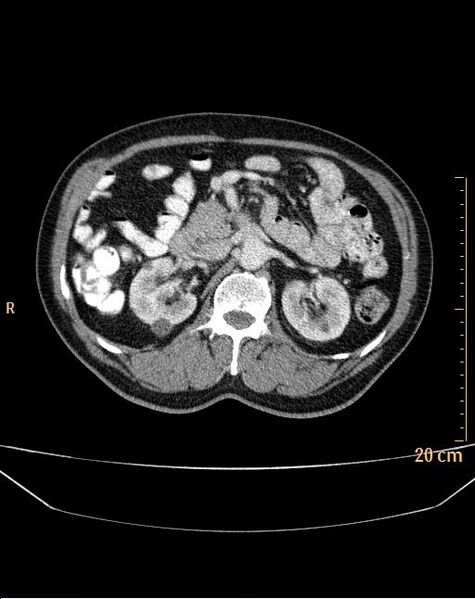 File:Abdominal aortic aneurysm (Radiopaedia 25985-26121 Axial C+ arterial phase 8).jpg
