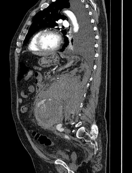 File:Abdominal aortic aneurysm rupture (Radiopaedia 54179-60362 Sagittal C+ arterial phase 27).jpg