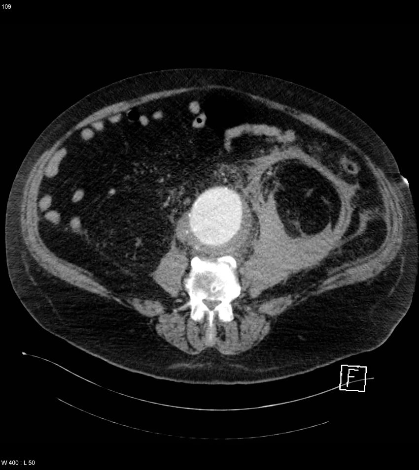 Abdominal aortic aneurysm with intramural hematoma then rupture (Radiopaedia 50278-55632 Axial C+ arterial phase 108).jpg