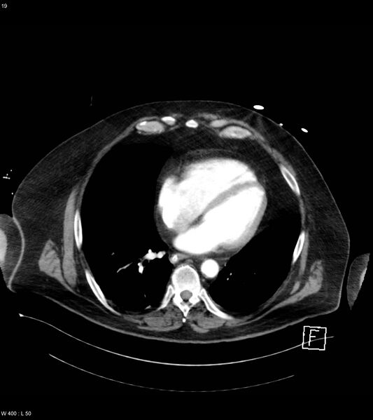 File:Abdominal aortic aneurysm with intramural hematoma then rupture (Radiopaedia 50278-55632 Axial C+ arterial phase 18).jpg