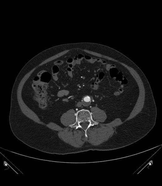 File:Abdominal aortic aneurysm with thrombus fissuration (Radiopaedia 46218-50618 Axial C+ arterial phase 24).jpg