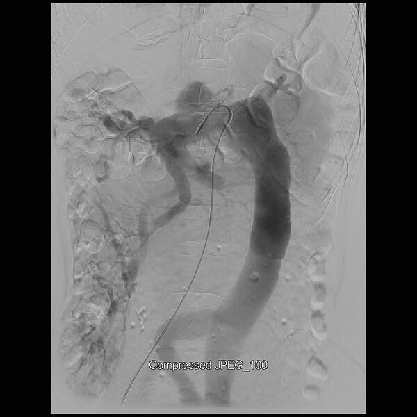 File:Abernethy malformation (Radiopaedia 42006-45462 Frontal Superior mesenteric artery 15).jpg