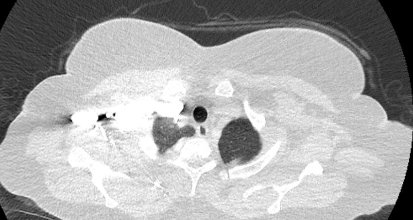 Accessory right inferior hepatic vein (Radiopaedia 65245-74259 Axial lung window 1).jpg