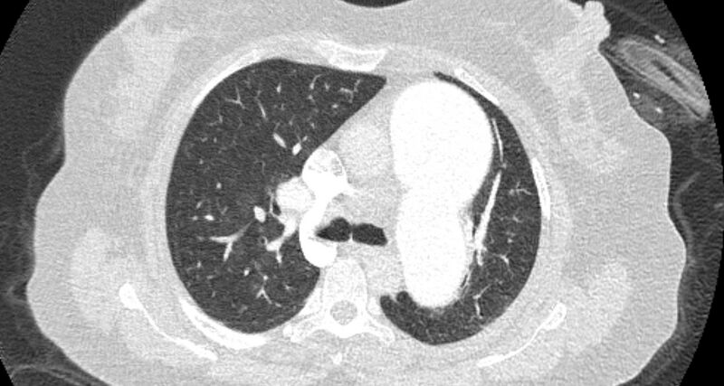File:Accessory right inferior hepatic vein (Radiopaedia 65245-74259 Axial lung window 23).jpg