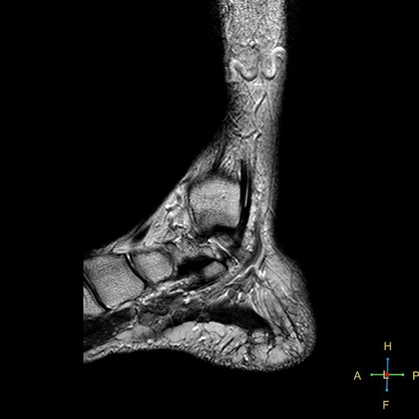 File:Achilles tendon complete tear (Radiopaedia 22834-22854 Sagittal T2 14).jpg