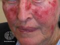 Actinic Keratoses treated with imiquimod (DermNet NZ lesions-ak-imiquimod-3740).jpg