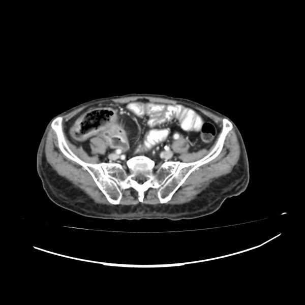 File:Acute-on-chronic Crohn disease with enteroenteric fistula (Radiopaedia 66686-75987 B 45).jpg