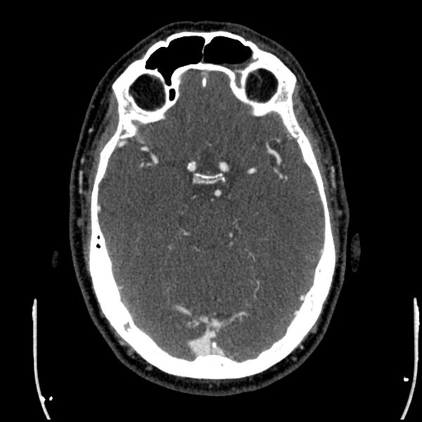 File:Acute A3 occlusion with ACA ischemic penumbra (CT perfusion) (Radiopaedia 72036-82527 Axial C+ arterial phase thins 109).jpg