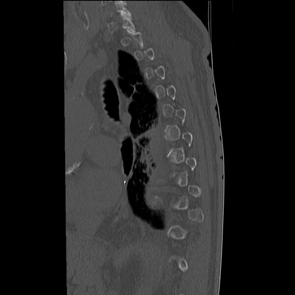 File:Acute and chronic vertebral compression fractures (Radiopaedia 31608-32494 Sagittal bone window 3).jpg
