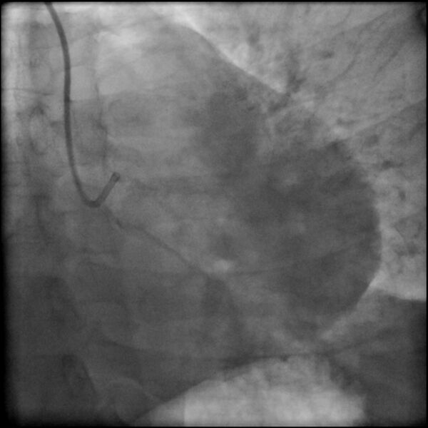 File:Acute anteroseptal myocardial infarction (Radiopaedia 68409-77946 LAO caudal (spider view) LAD and CX 10).jpg