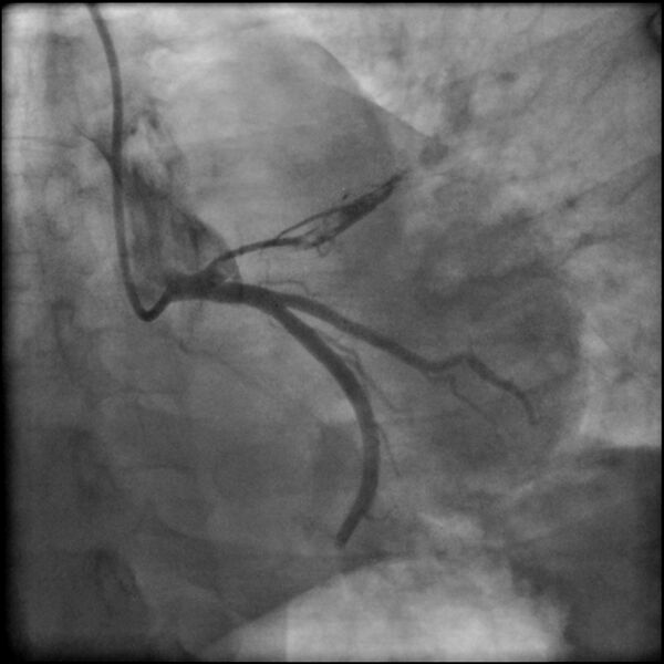 File:Acute anteroseptal myocardial infarction (Radiopaedia 68409-77946 LAO caudal (spider view) LAD and CX 20).jpg