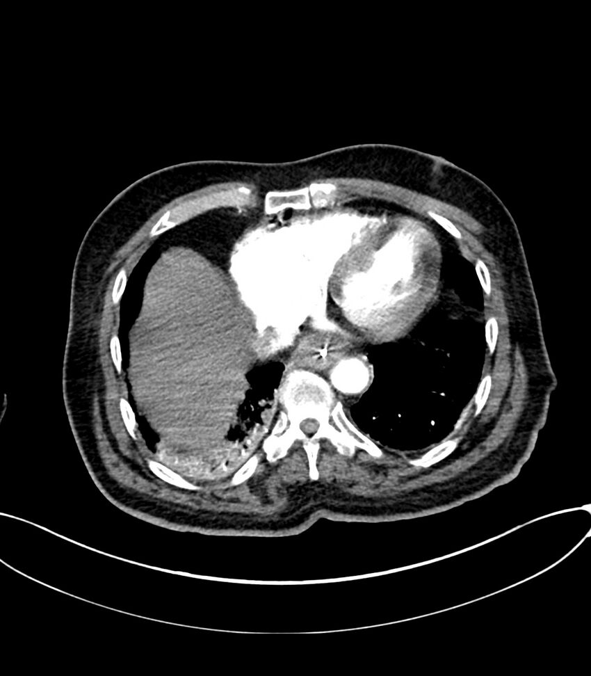 Acute arterial mesenteric ischemia (Radiopaedia 78238-90828 Axial C+ arterial phase 17).jpg