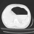 Acute aspiration pneumonitis (Radiopaedia 33605-34703 Axial lung window 96).jpg