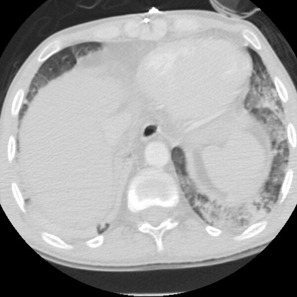 File:Acute diffuse alveolar hemorrhage (Radiopaedia 41323-44158 Axial lung window 54).jpg