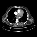 Acute heart failure (CT) (Radiopaedia 79835-93075 Axial C+ arterial phase 29).jpg