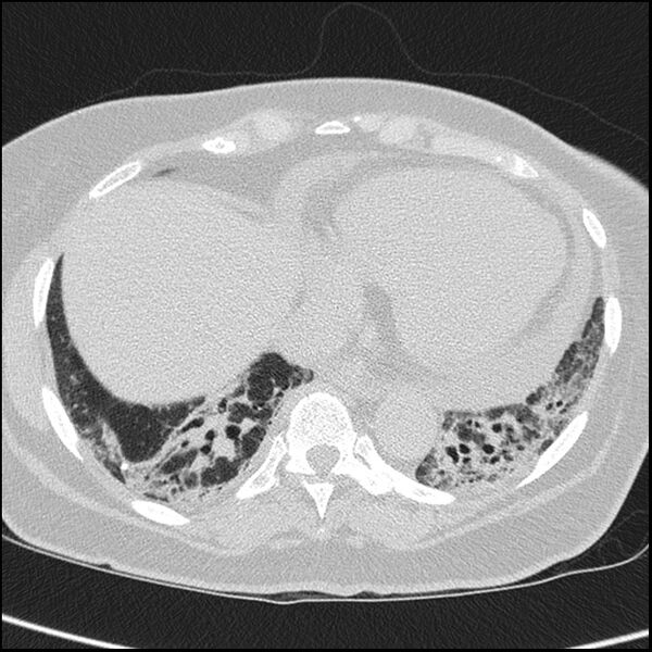 File:Acute interstitial pneumonitis (Radiopaedia 45404-49453 Axial lung window 60).jpg
