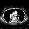 Acute myocardial infarction in CT (Radiopaedia 39947-42415 Axial C+ arterial phase 66).jpg