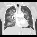 Acute pulmonary edema on CT (Radiopaedia 33582-34672 Coronal lung window 16).jpg