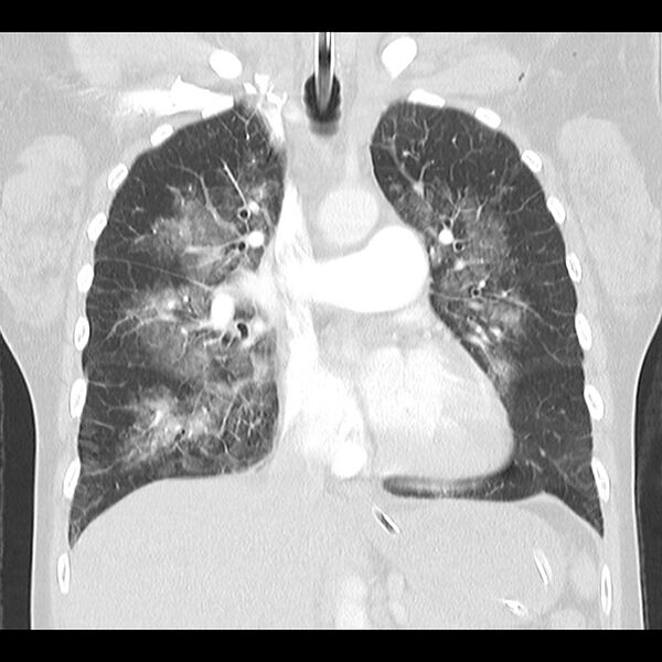 File:Acute pulmonary edema on CT (Radiopaedia 33582-34672 Coronal lung window 16).jpg