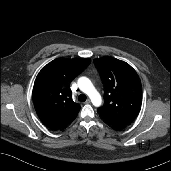 File:Acute pulmonary embolism with pulmonary infarct (Radiopaedia 73062-83768 Axial C+ CTPA 22).jpg