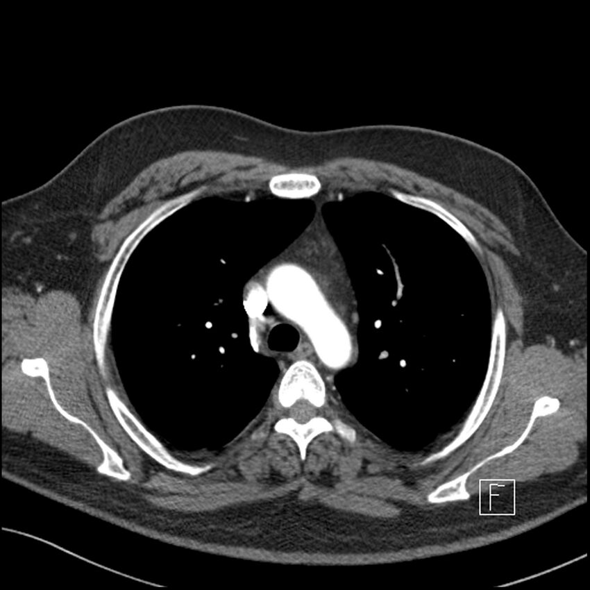Acute pulmonary embolism with pulmonary infarct (Radiopaedia 73062-83768 Axial C+ CTPA 22).jpg