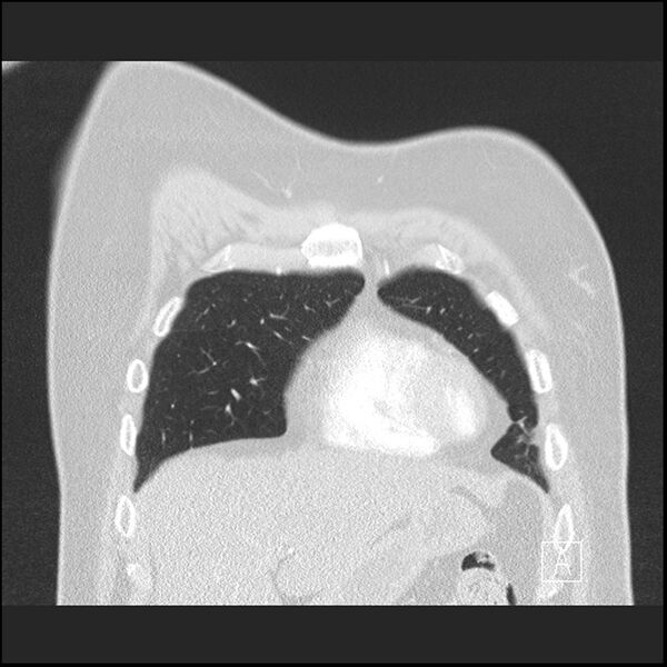 File:Acute pulmonary embolism with pulmonary infarct (Radiopaedia 73062-83768 Coronal lung window 13).jpg