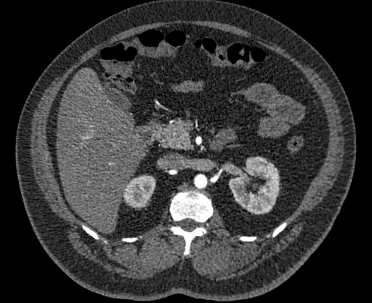 File:Acute pulmonary embolism with pulmonary infarcts (Radiopaedia 77688-89908 Axial C+ CTPA 88).jpg