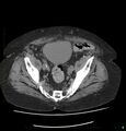 Acute renal failure post IV contrast injection- CT findings (Radiopaedia 47815-52557 Axial non-contrast 67).jpg