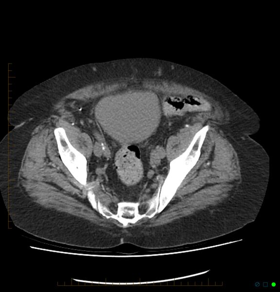 File:Acute renal failure post IV contrast injection- CT findings (Radiopaedia 47815-52557 Axial non-contrast 67).jpg