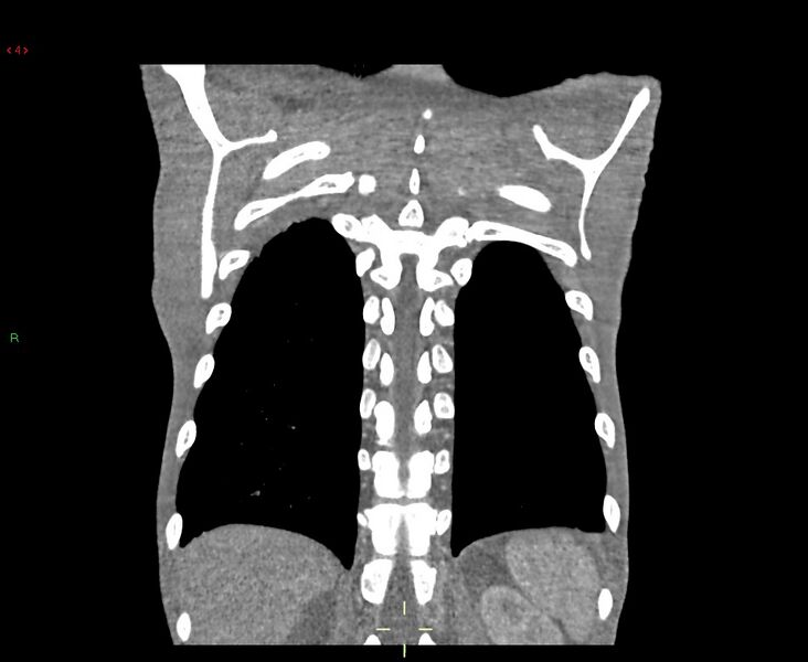 File:Acute right lung abscess (Radiopaedia 34806-36258 Coronal C+ arterial phase 6).jpg