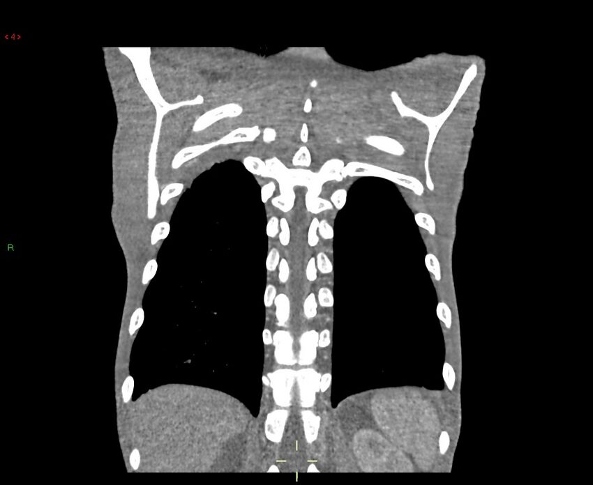 Acute right lung abscess (Radiopaedia 34806-36258 Coronal C+ arterial phase 6).jpg