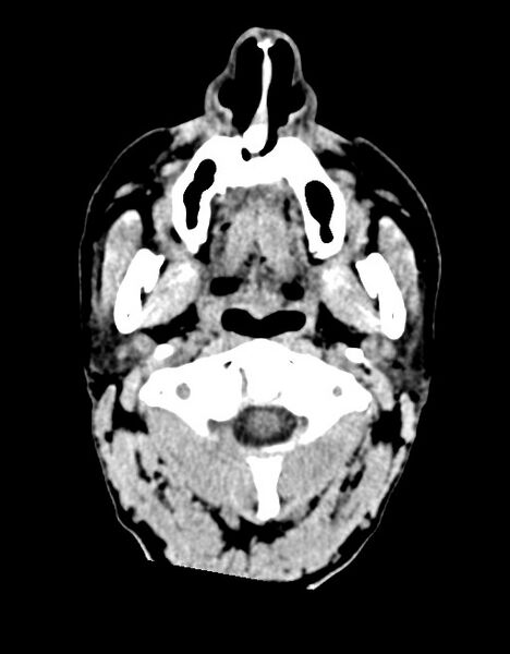 File:Acute superior cerebellar artery territory infarct (Radiopaedia 84104-99359 Axial non-contrast 70).jpg