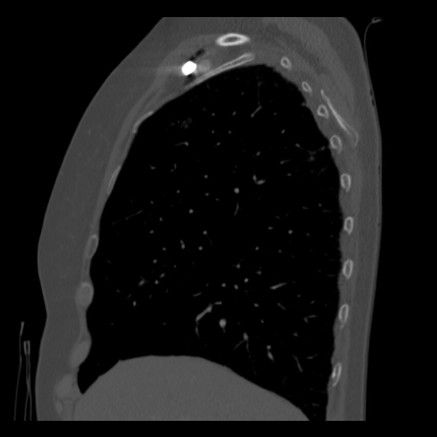 Adenocarcinoma of the lung (Radiopaedia 41015-43755 Sagittal bone window 23).jpg