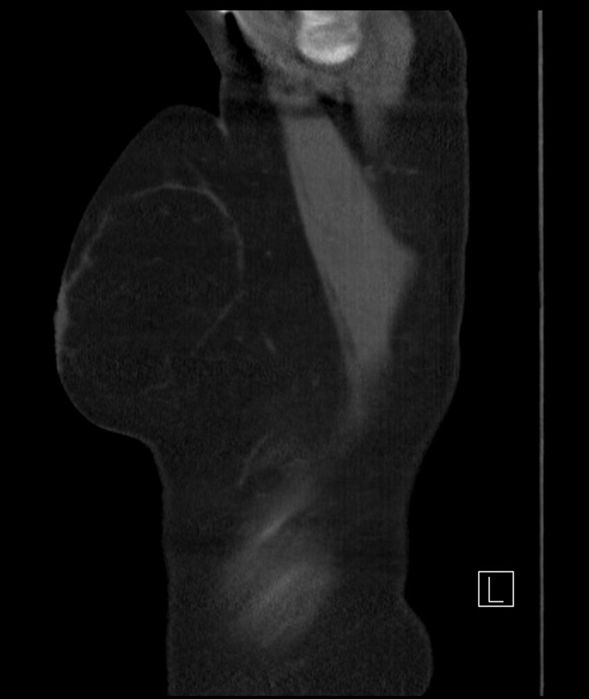 Adenocarcinoma of the lung (Radiopaedia 44205-47803 Sagittal C+ portal venous phase 56).jpg