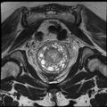 Adenoma malignum of the cervix (Radiopaedia 24460-24765 Coronal T2 19).jpg
