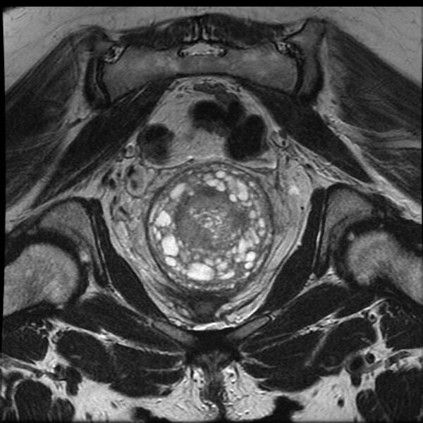 File:Adenoma malignum of the cervix (Radiopaedia 24460-24765 Coronal T2 19).jpg