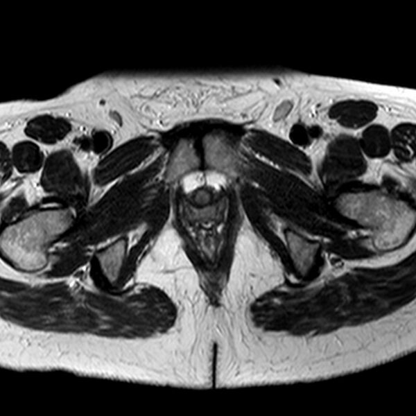 File:Adenomyoma of the uterus (Radiopaedia 9871-10439 Axial T2 4).jpg