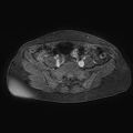 Adenomyoma of the uterus (huge) (Radiopaedia 9870-10438 Axial T1 C+ fat sat 25).jpg