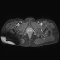 Adenomyoma of the uterus (huge) (Radiopaedia 9870-10438 Axial T1 C+ fat sat 3).jpg