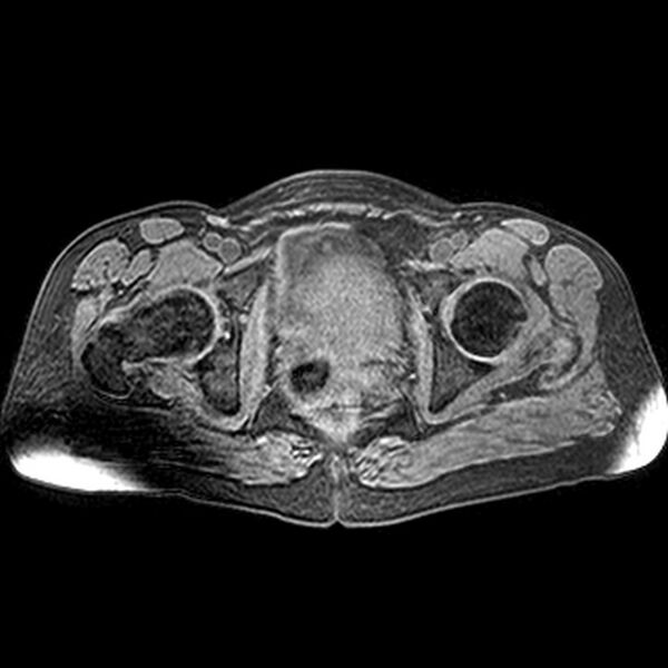 File:Adenomyoma of the uterus (huge) (Radiopaedia 9870-10438 Axial T1 fat sat 9).jpg