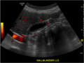 Adenomyomatosis of the gallbladder (Radiopaedia 42505).png