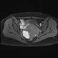 Adenomyosis and endometriotic cysts (Radiopaedia 82300-96367 Axial T1 C+ fat sat 13).jpg