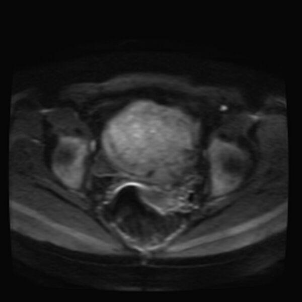File:Adenomyosis on MRI (Radiopaedia 29328-29780 Axial DWI 9).jpg