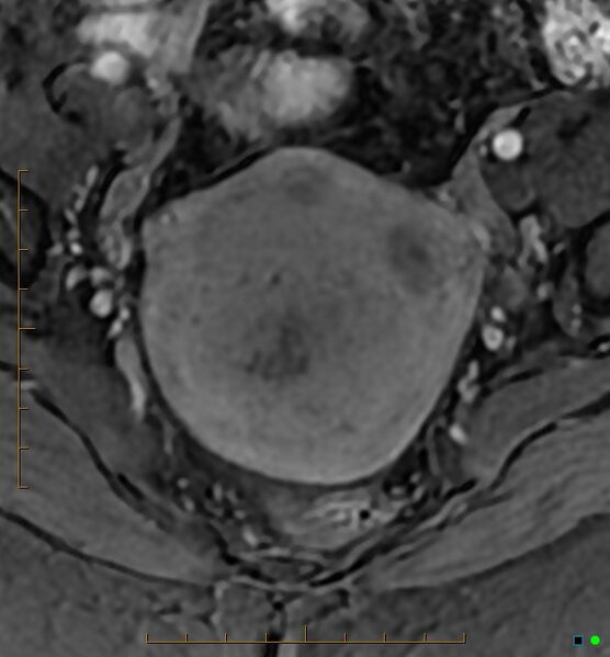 File:Adenomyosis uterus with hematometra (Radiopaedia 45779-50011 Axial T1 C+ fat sat 21).jpg
