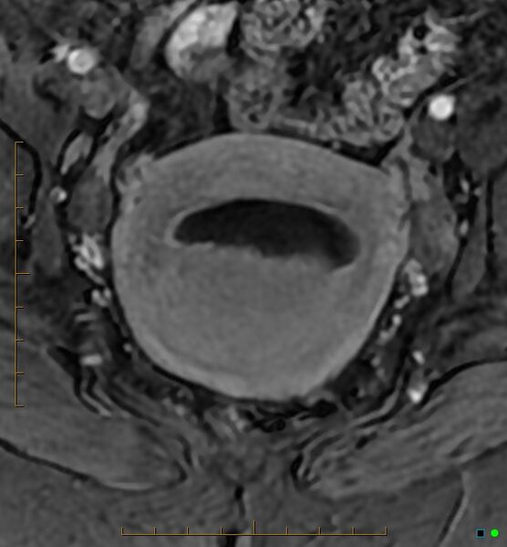 File:Adenomyosis uterus with hematometra (Radiopaedia 45779-50011 Axial T1 C+ fat sat 31).jpg