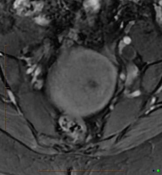 File:Adenomyosis uterus with hematometra (Radiopaedia 45779-50011 Axial T1 C+ fat sat 8).jpg