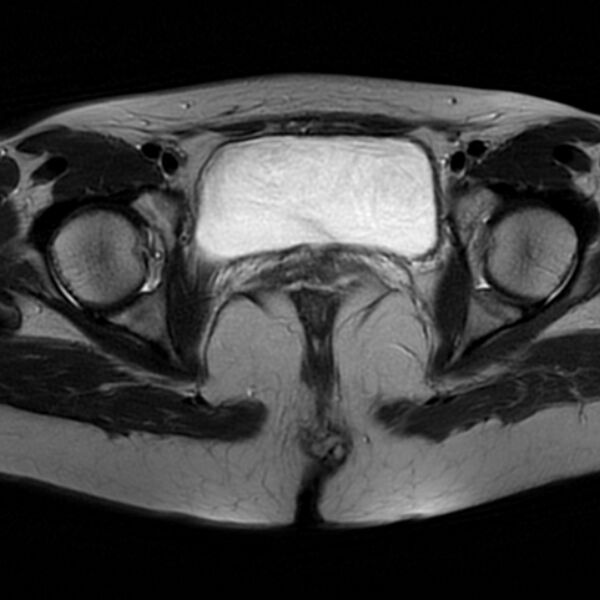 File:Adenomyosis within a septate uterus (Radiopaedia 69963-79981 Axial T2 25).jpg
